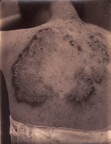 Anonymous, Skin decease #2