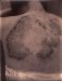 Anonymous, Skin decease #2